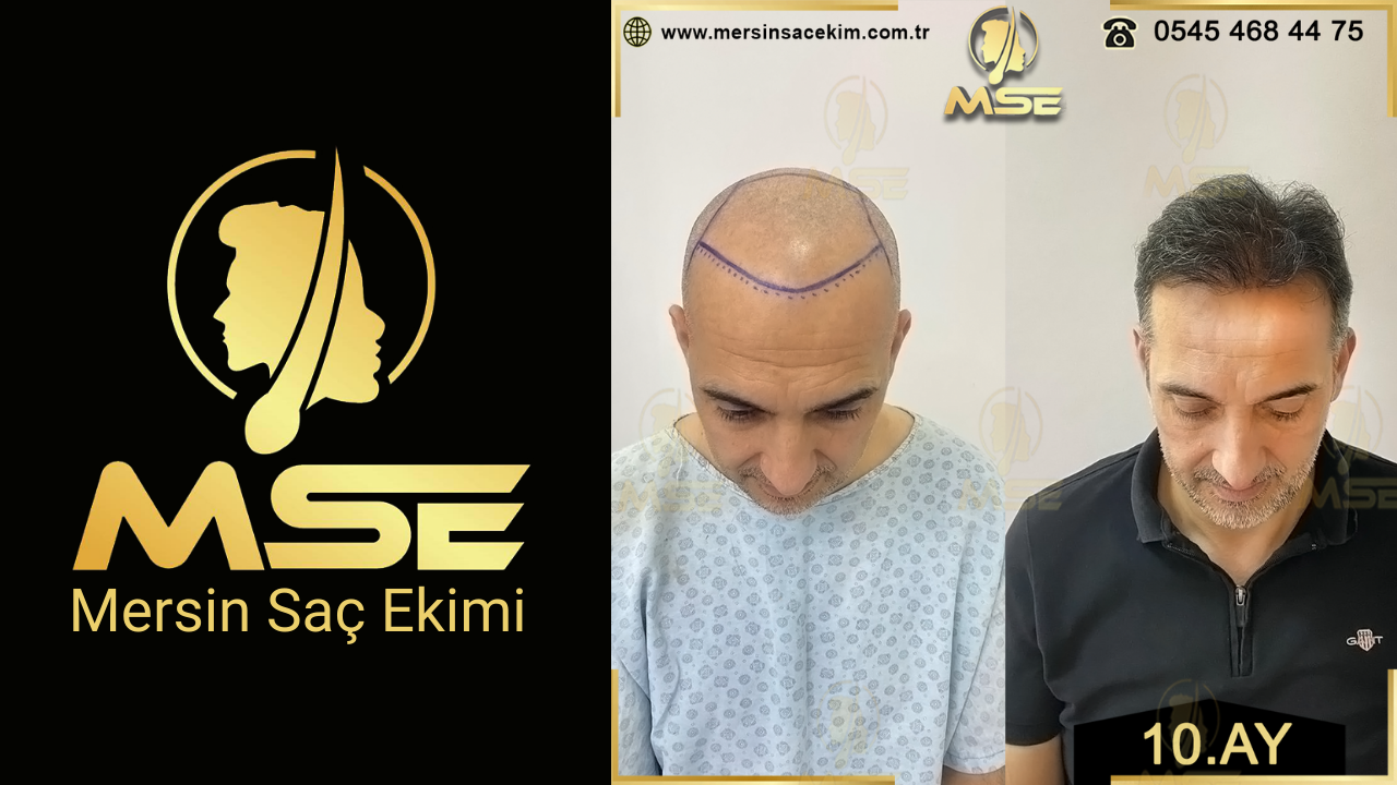 Mersin Saç Ekimi